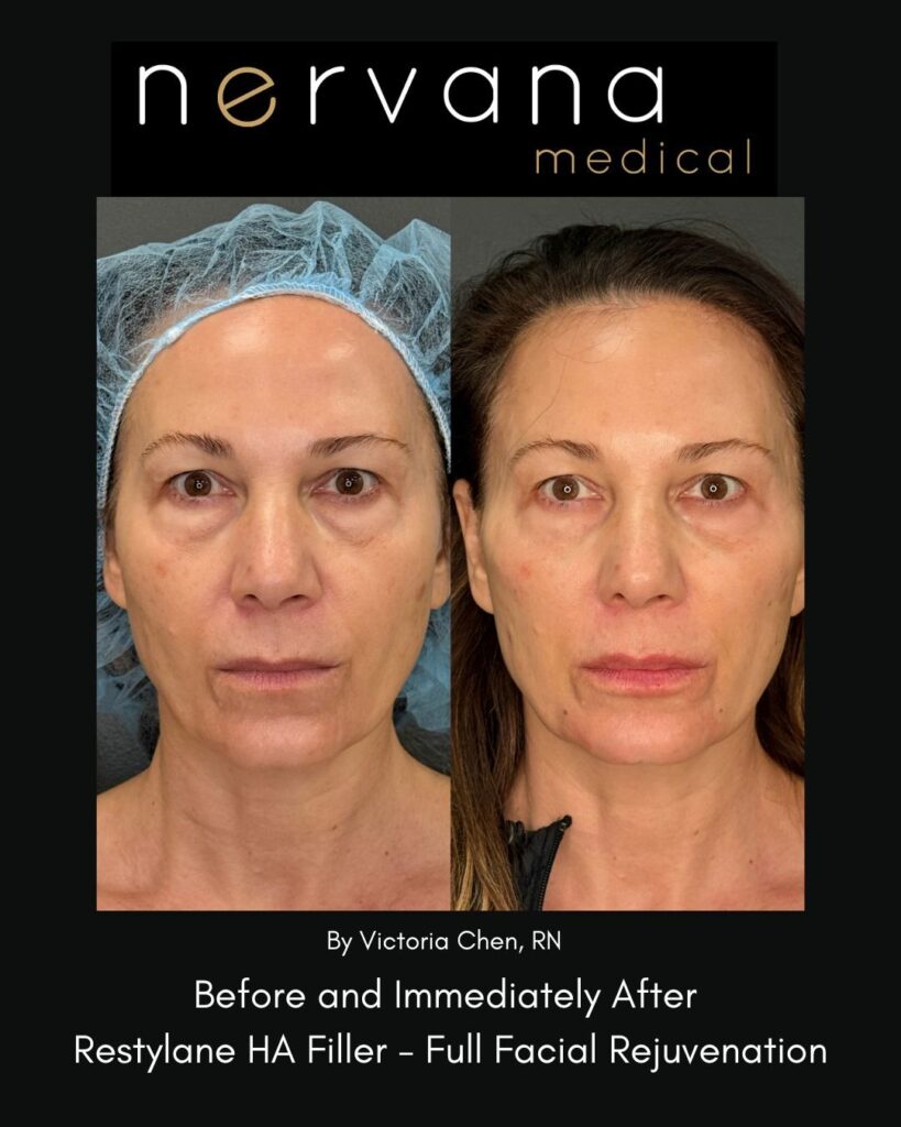 Before and After Image: Restylane Full Facial Rejuvenation — Before & After | Sandy UT - front