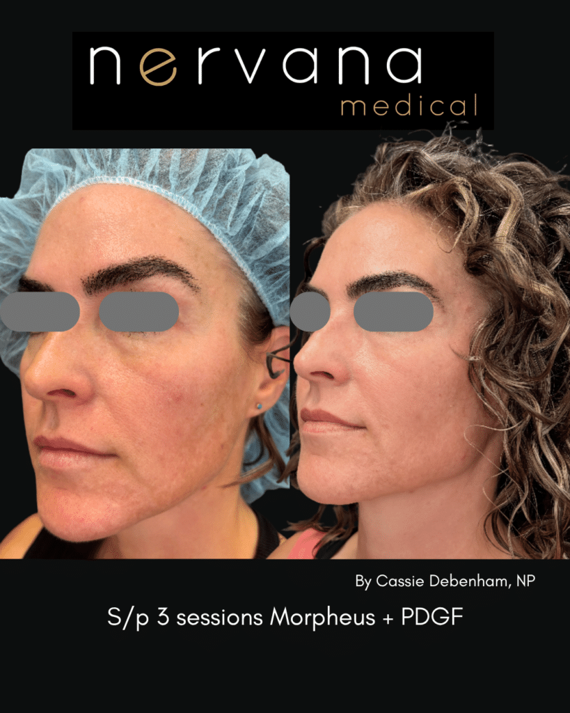 Before and After Image: Morpheus8 + PDGF — Face (3 Sessions) - front