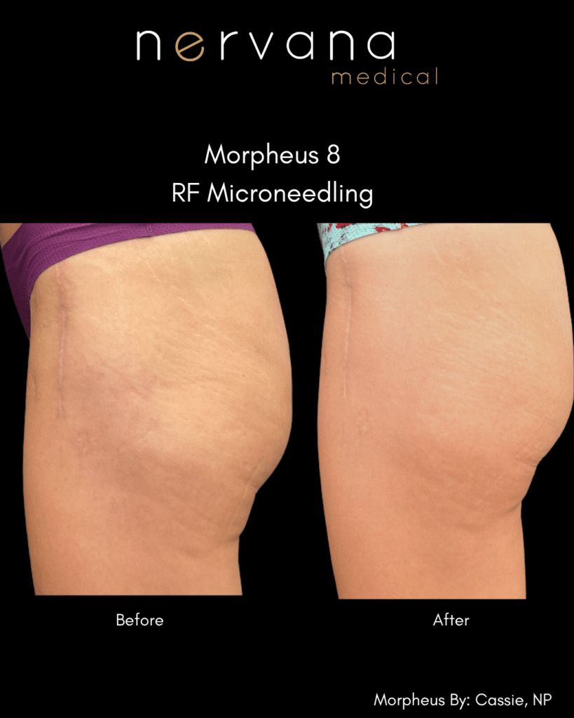 Before and After Image: Morpheus8 — Stretch Marks (Hip) - front