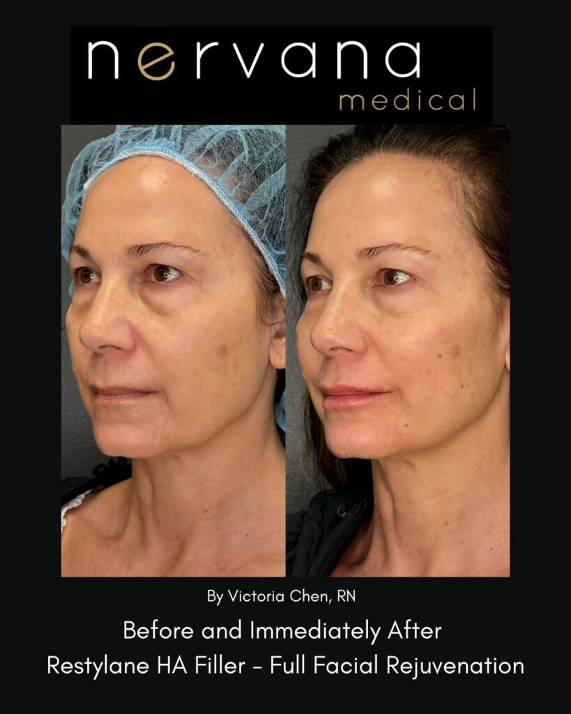 Before and After Image: Restylane Full Facial Rejuvenation — Before & After | Sandy UT - left-front-oblique