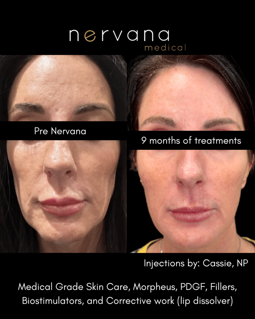 Before and After Image: Nine Months at Nervana — Face - front