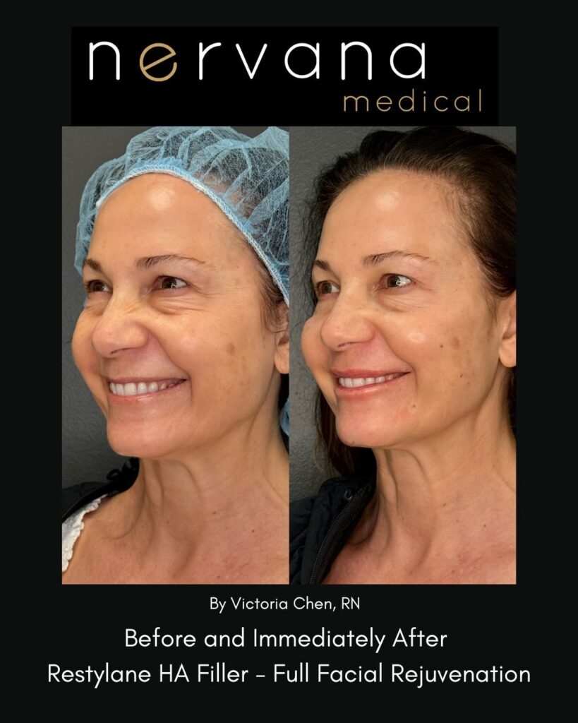 Before and After Image: Restylane Full Facial Rejuvenation — Before & After | Sandy UT - left-front-oblique