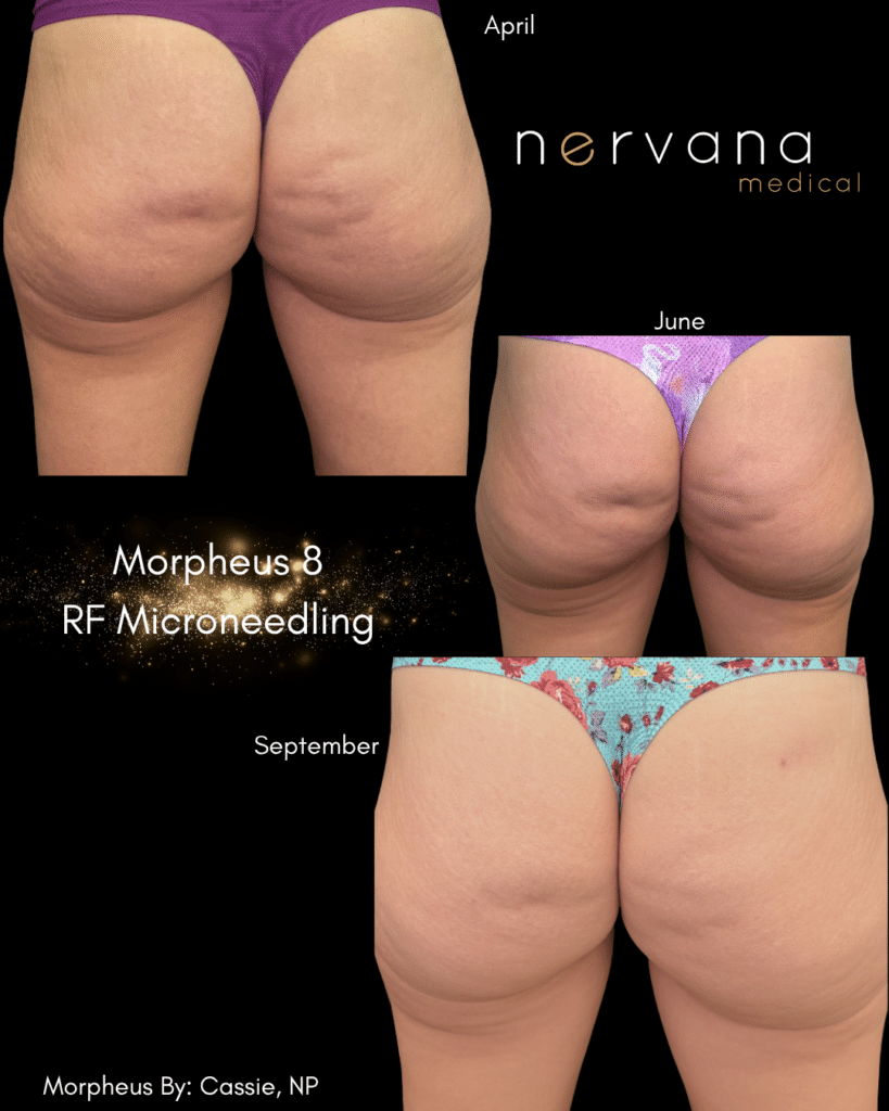 Before and After Image: Morpheus8 — Body (April to September) - front