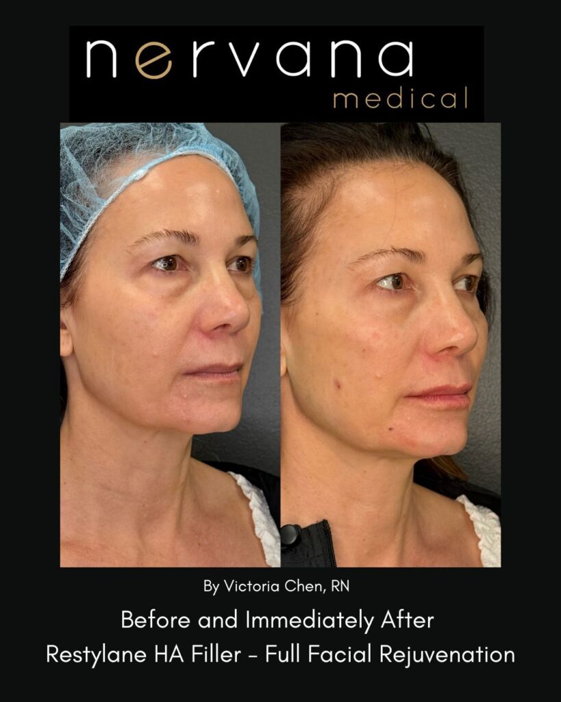 Before and After Image: Restylane Full Facial Rejuvenation — Before & After | Sandy UT - right-front-oblique