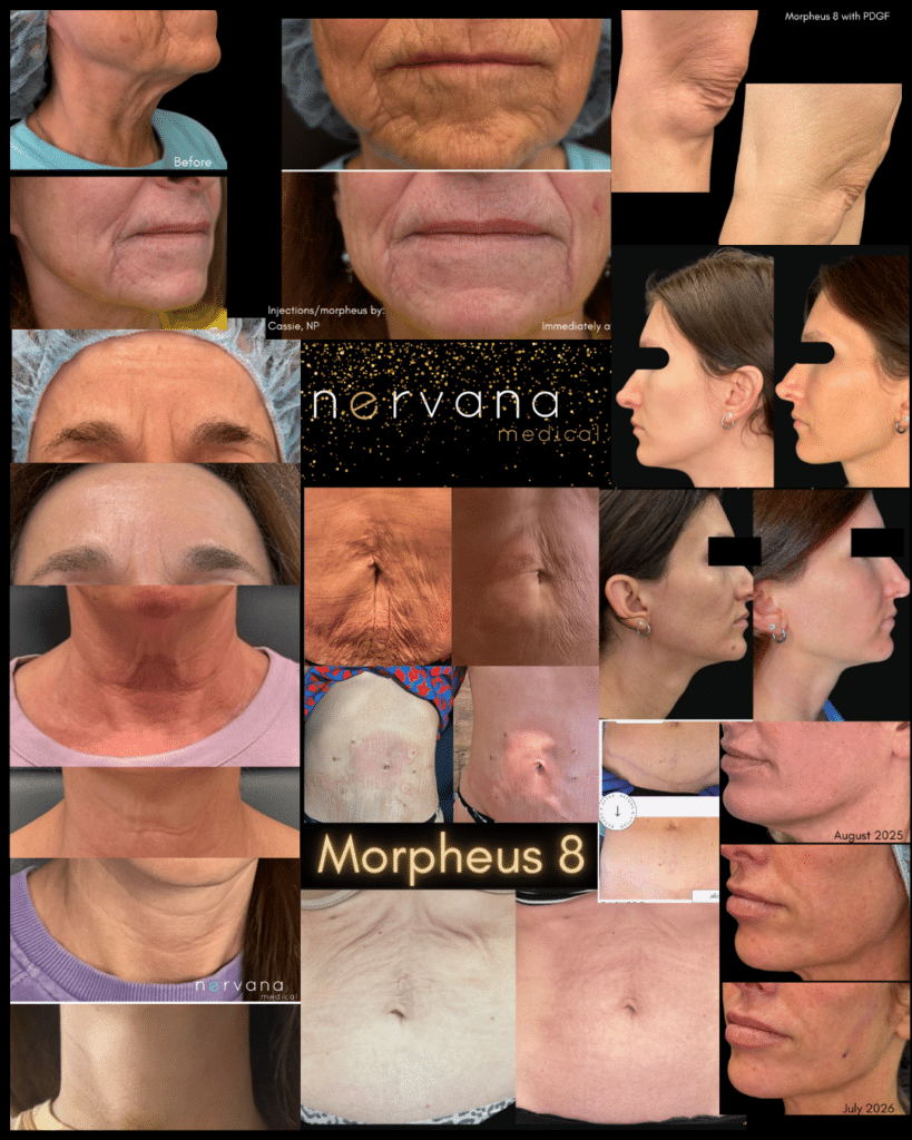 Before and After Image: Morpheus8 Results Collage - front