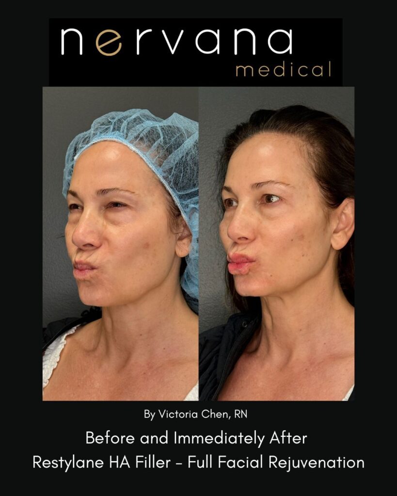 Before and After Image: Restylane Full Facial Rejuvenation — Before & After | Sandy UT - other