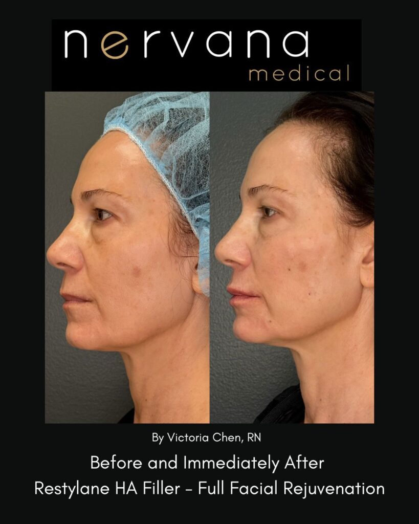 Before and After Image: Restylane Full Facial Rejuvenation — Before & After | Sandy UT - left-side