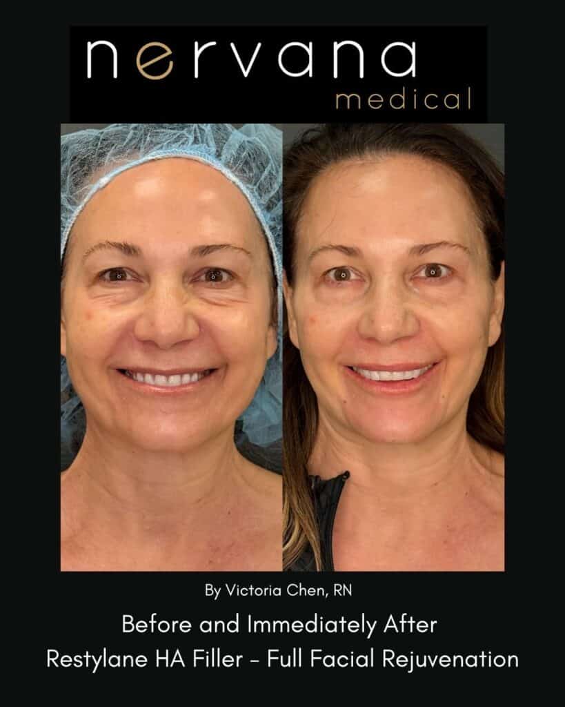 Before and After Image: Restylane Full Facial Rejuvenation — Before & After | Sandy UT - front