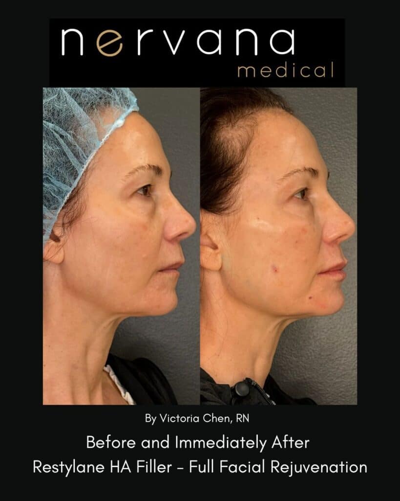 Before and After Image: Restylane Full Facial Rejuvenation — Before & After | Sandy UT - right-side