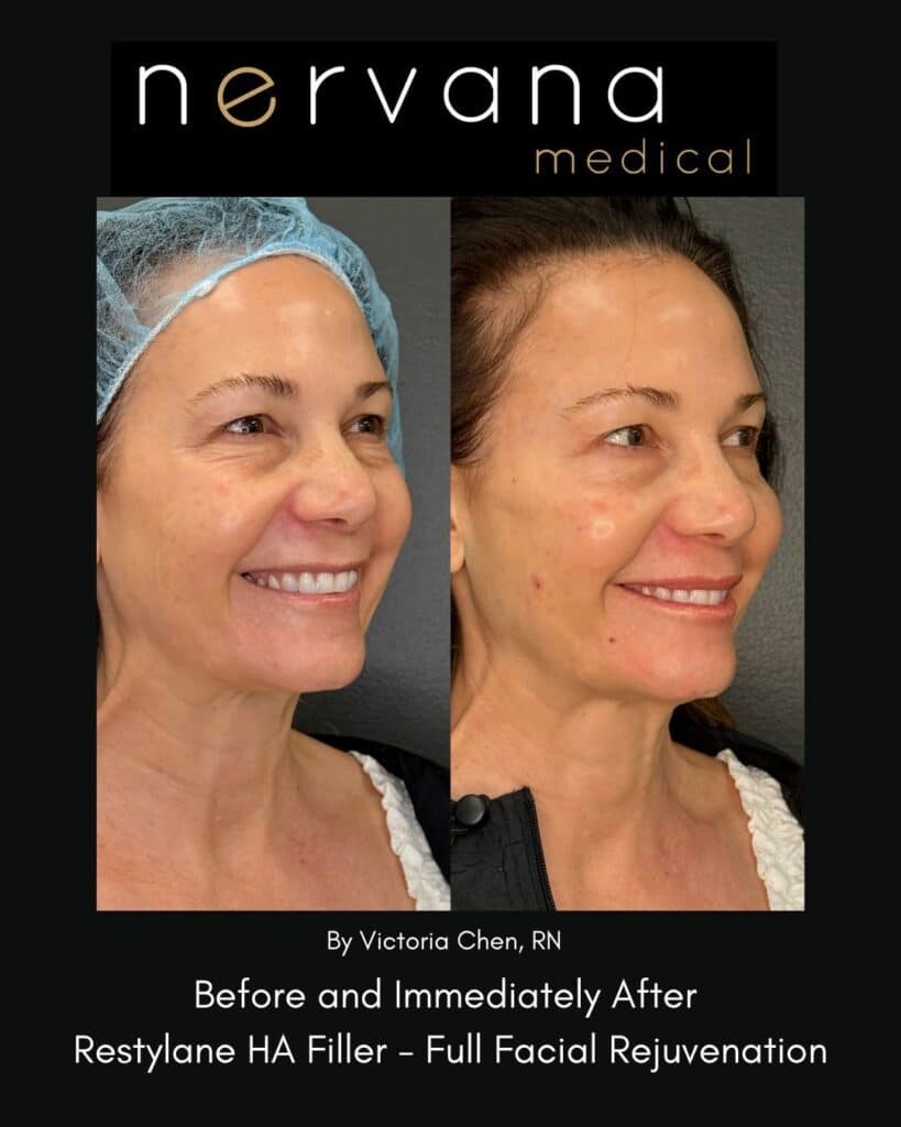 Before and After Image: Restylane Full Facial Rejuvenation — Before & After | Sandy UT - right-front-oblique