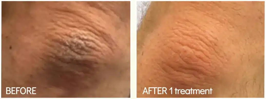 BioRePeel before and after on rough, textured body skin after 1 treatment (manufacturer photo)