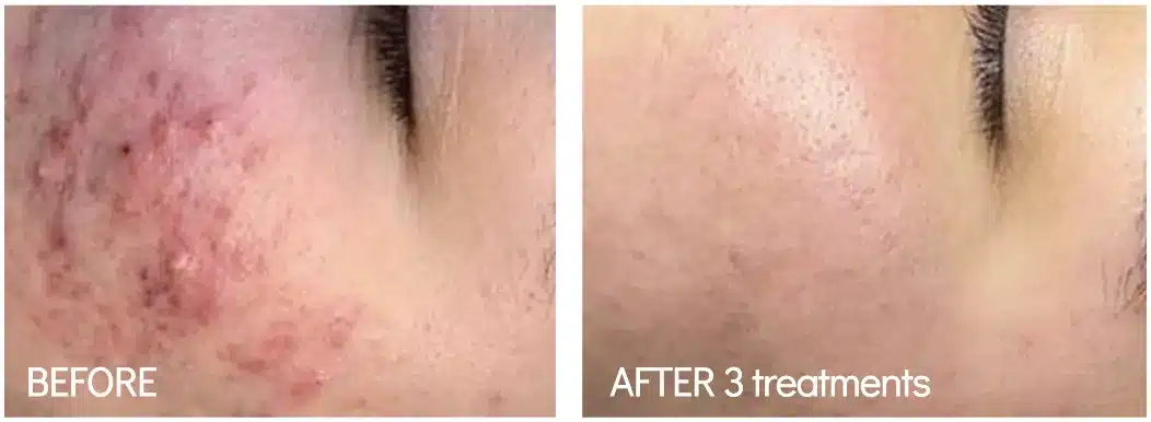 BioRePeel before and after on the cheek, showing active acne before and after 3 treatments (manufacturer photo)