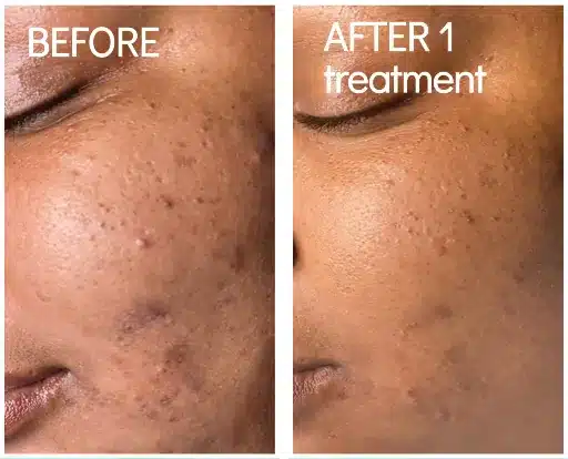 BioRePeel before and after on the cheek of a deeper skin tone, showing dark spots and blemishes before and after 1 treatment (manufacturer photo)