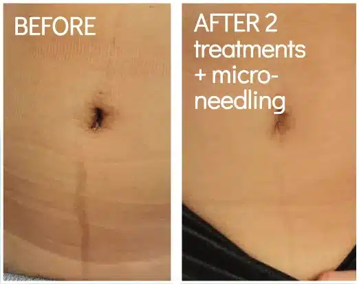 BioRePeel combined with microneedling, before and after on the abdomen after 2 treatments (manufacturer photo)