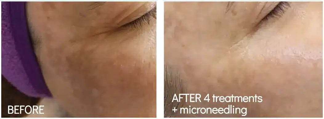 BioRePeel combined with microneedling, before and after on the cheek and under-eye area after 4 treatments (manufacturer photo)