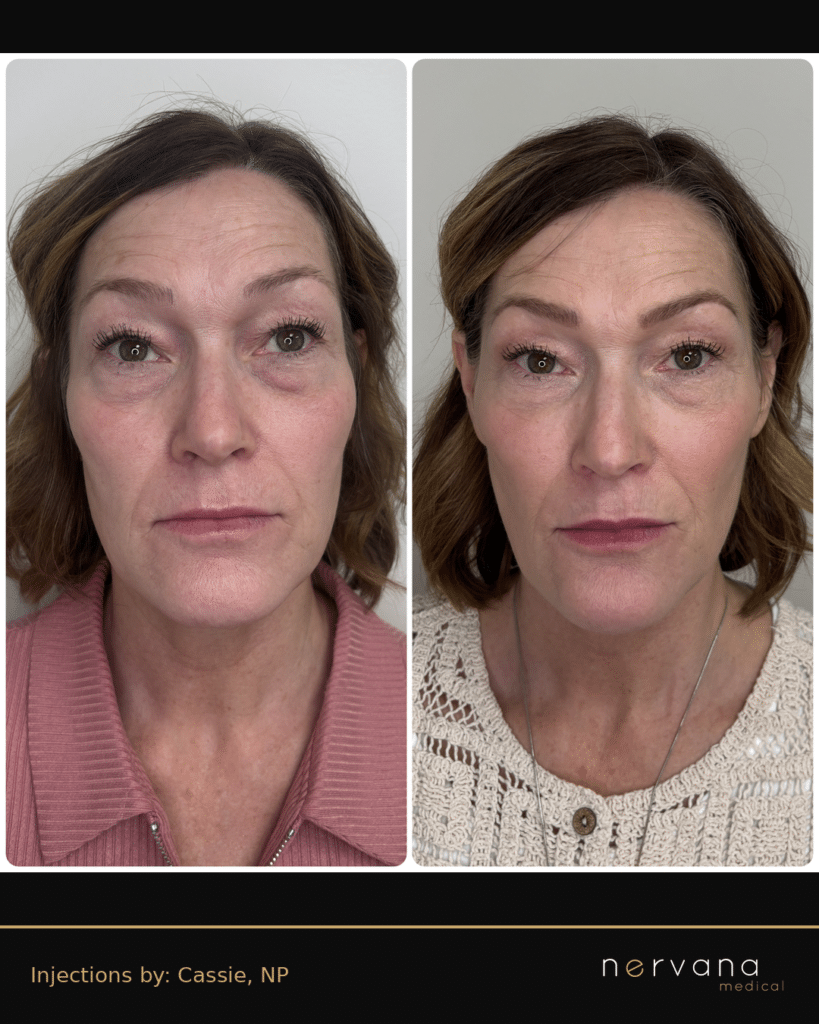 Before and After Image: Full Face Filler Rejuvenation — Front - front