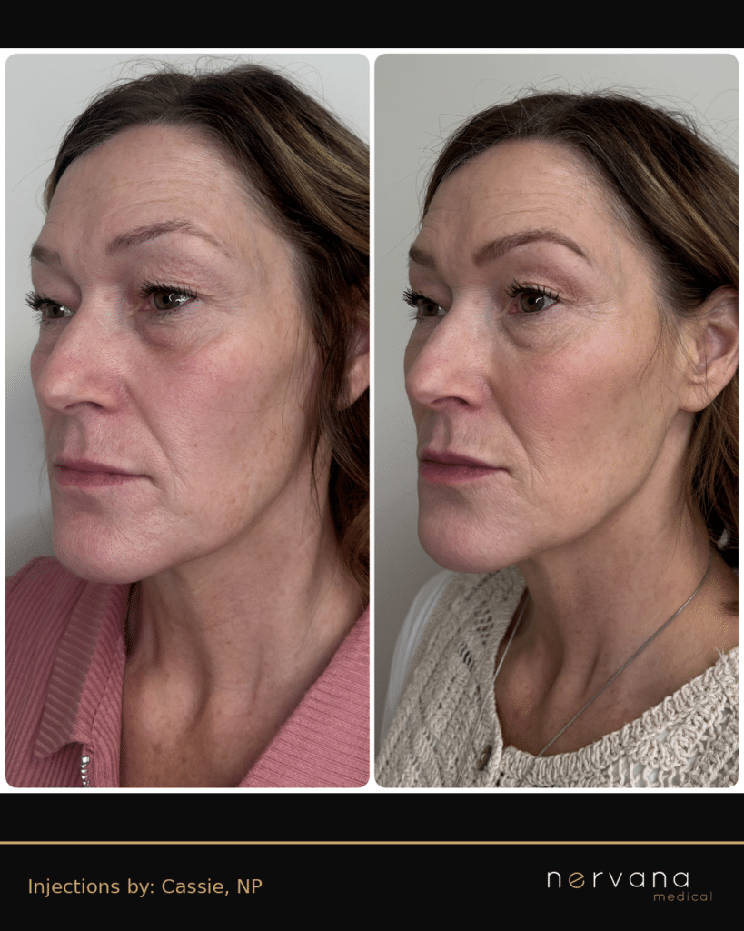 Before and After Image: Full Face Filler Before & After | 3/4 | Sandy, UT - right-front-oblique