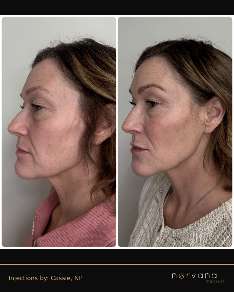 Before and After Image: Full Face Filler Rejuvenation — Left Profile - left-side