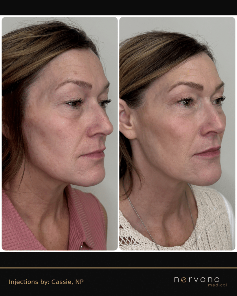 Before and After Image: Full Face Filler Rejuvenation — Right Profile - right-side