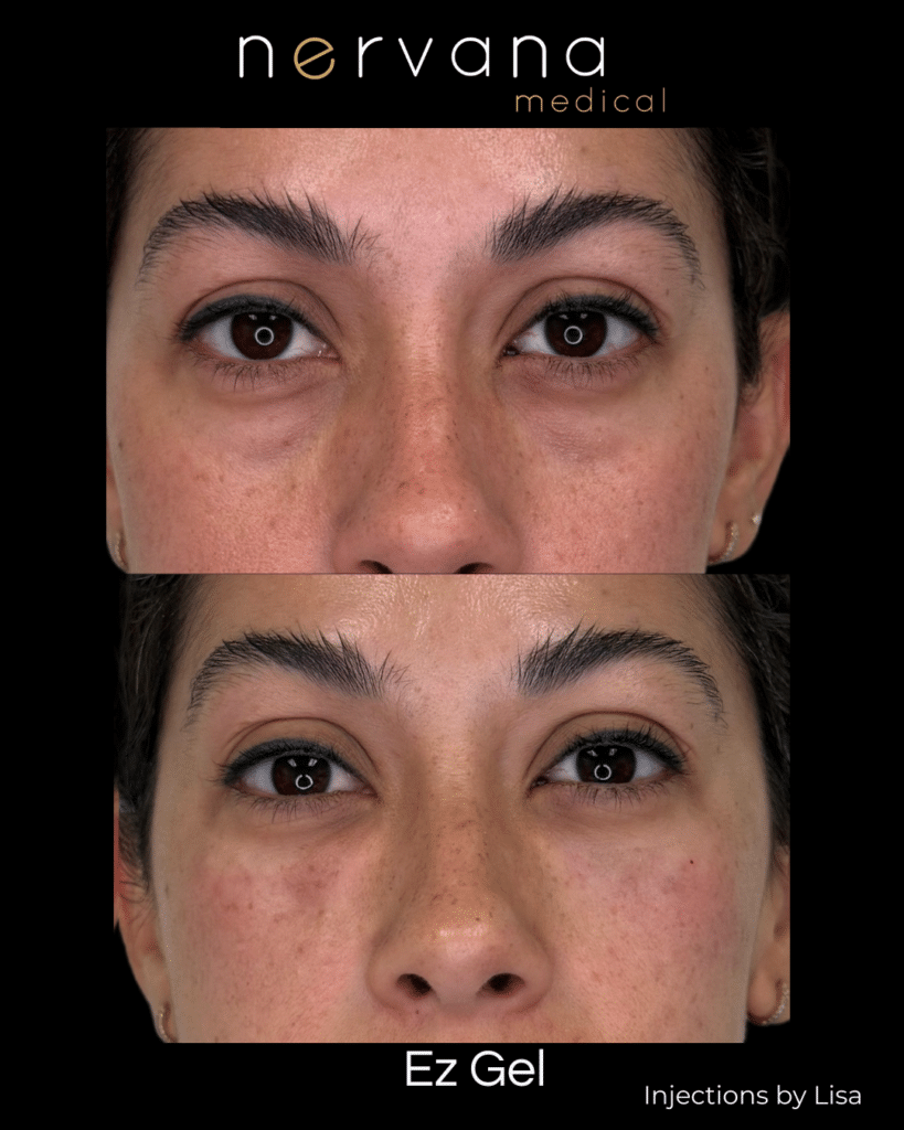 Before and After Image: EZ Gel — Under Eyes (Front) - front