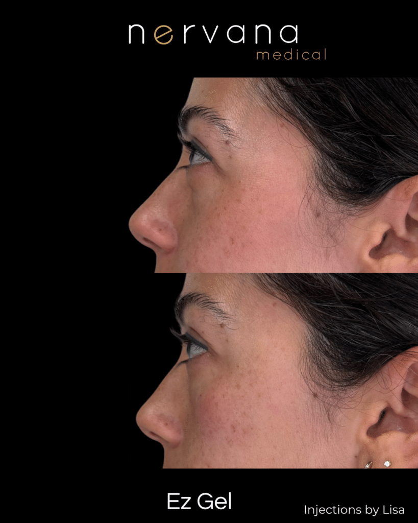 Before and After Image: EZ Gel Under Eyes — Before & After - left-side
