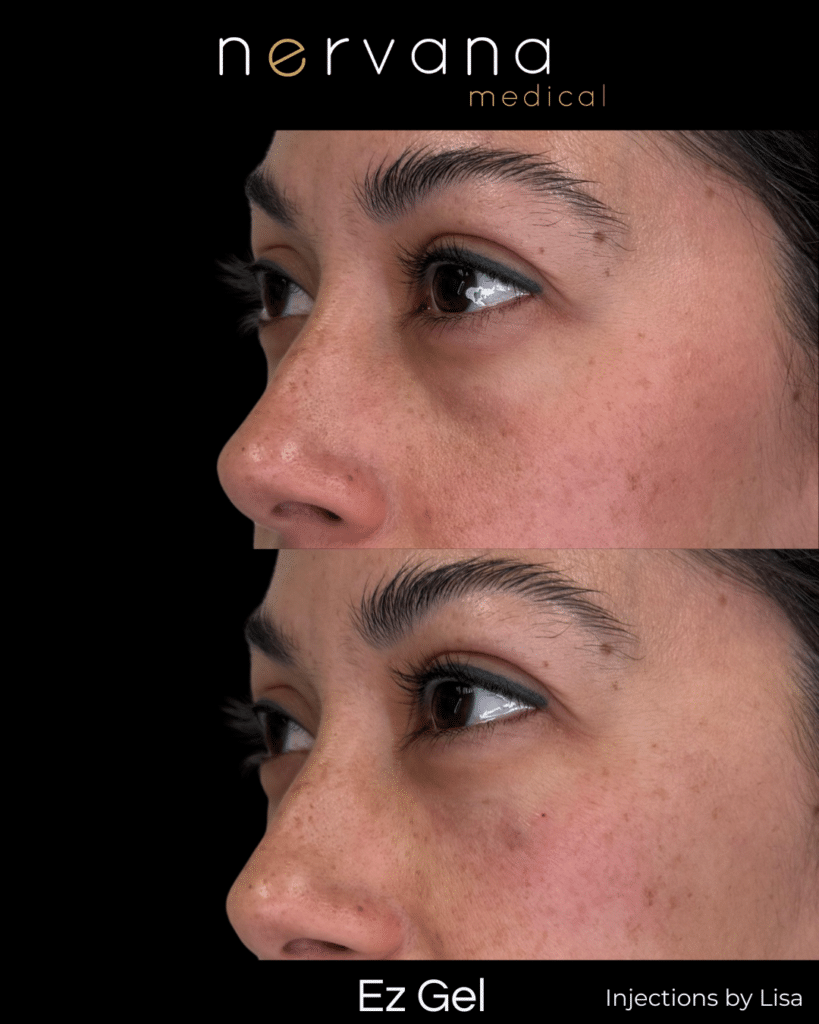 Before and After Image: EZ Gel Under Eyes — Before & After - left-front-oblique