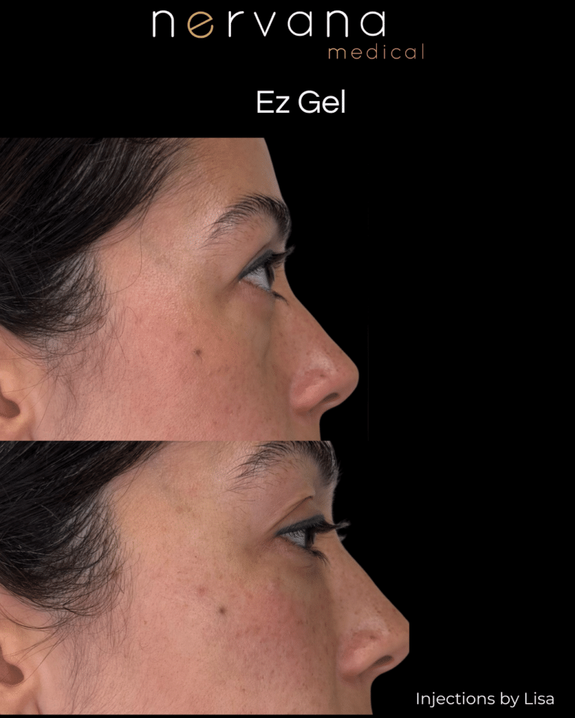 Before and After Image: EZ Gel — Under Eyes (Right Profile) - right-side