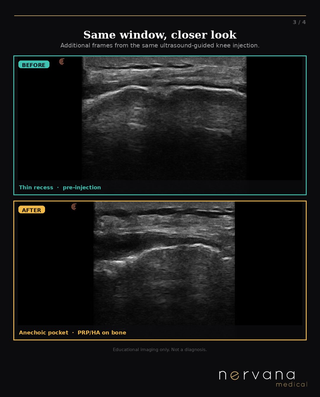 Side-by-side knee ultrasound frames before and after an ultrasound-guided PRP and hyaluronic acid injection, showing a thin joint recess before and a fluid-filled pocket after.