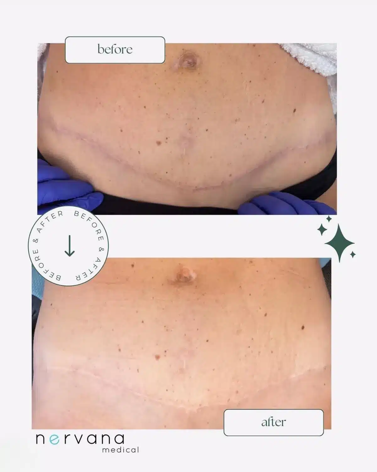 Morpheus8 and BioRePeel combination before and after on a lower-abdomen scar, Nervana Medical patient in Sandy, UT