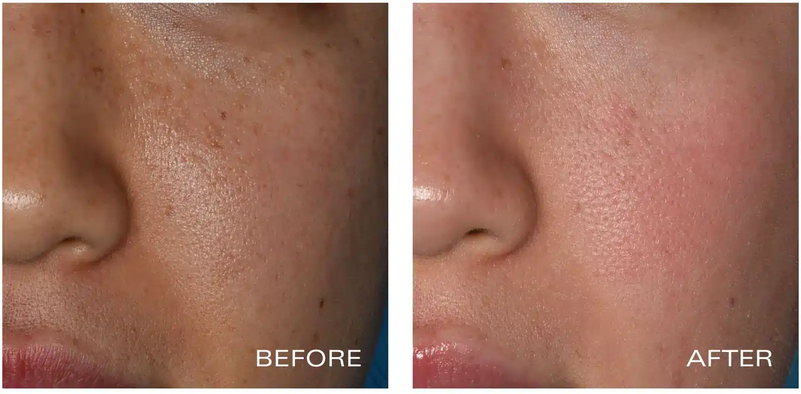 ZO 3-Step Peel before and after close-up of the cheek, showing brown spots and uneven pigmentation before treatment (manufacturer photo)