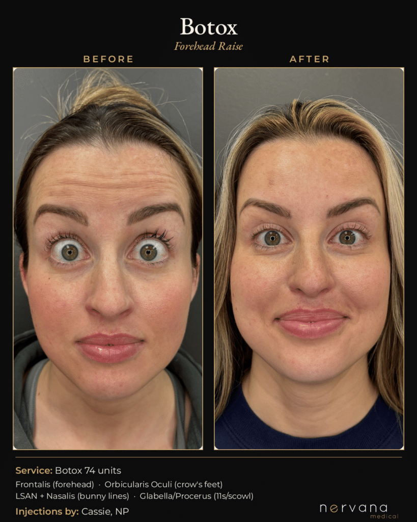 Before and After Image: Botox Before and After Sandy UT: 74 Units, Full Upper Face - other