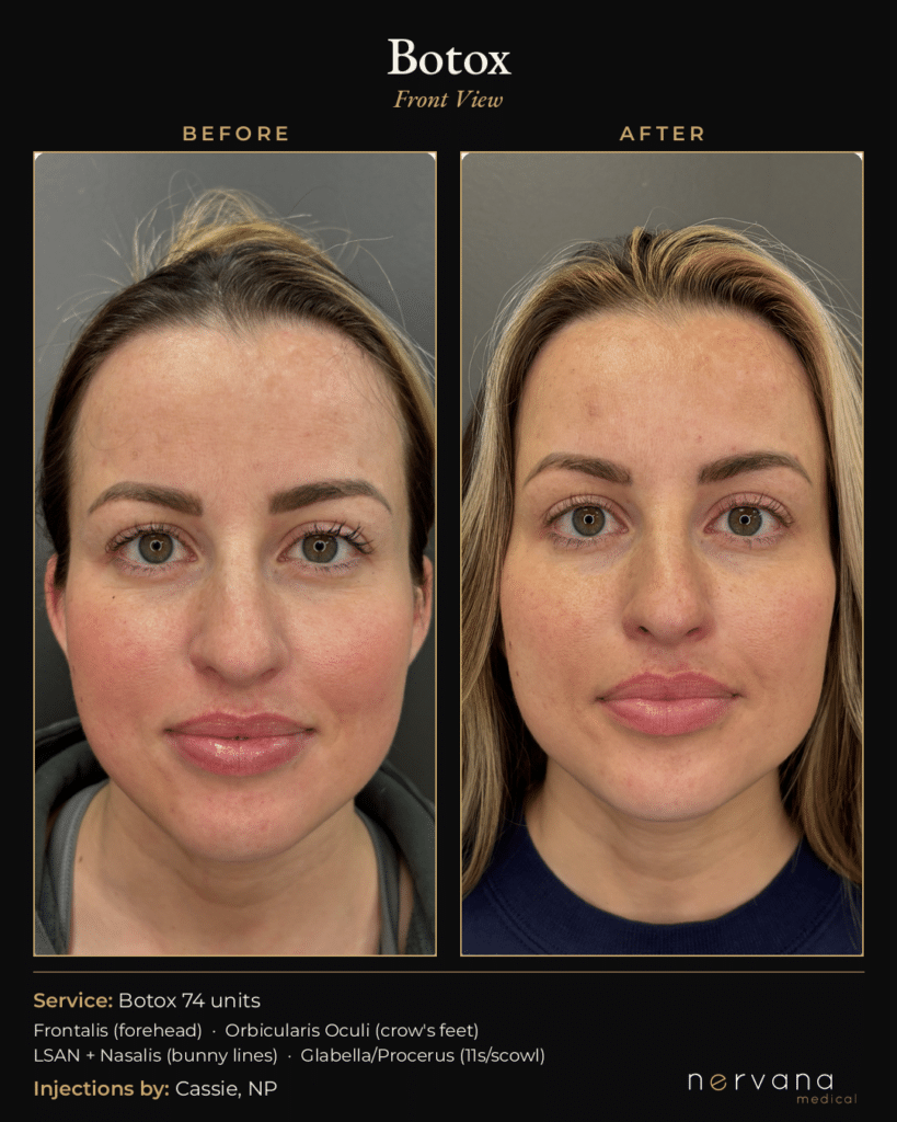Botox before and after Sandy UT