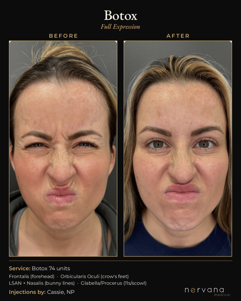 Before and After Image: Botox Before and After Sandy UT: 74 Units, Full Upper Face - other