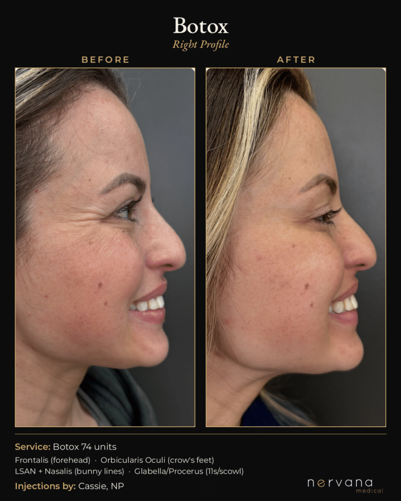 Before and After Image: Botox Before and After Sandy UT: 74 Units, Full Upper Face - right-side