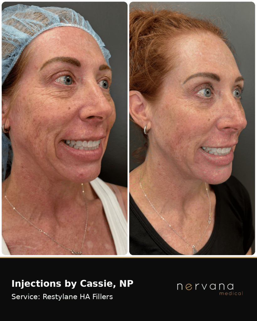 Before and After Image: Restylane Full-Face Filler Before & After, Sandy UT (Second Case) - right-front-oblique