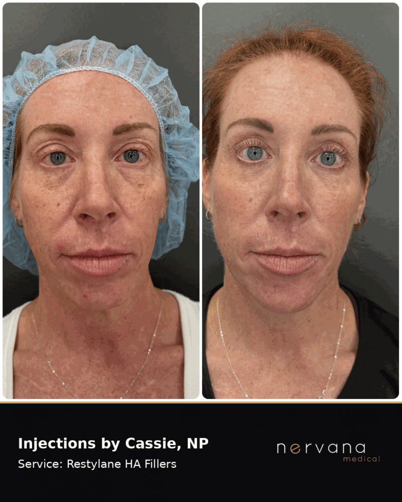 Before and After Image: Restylane Full-Face Filler Before & After, Sandy UT (Second Case) - front