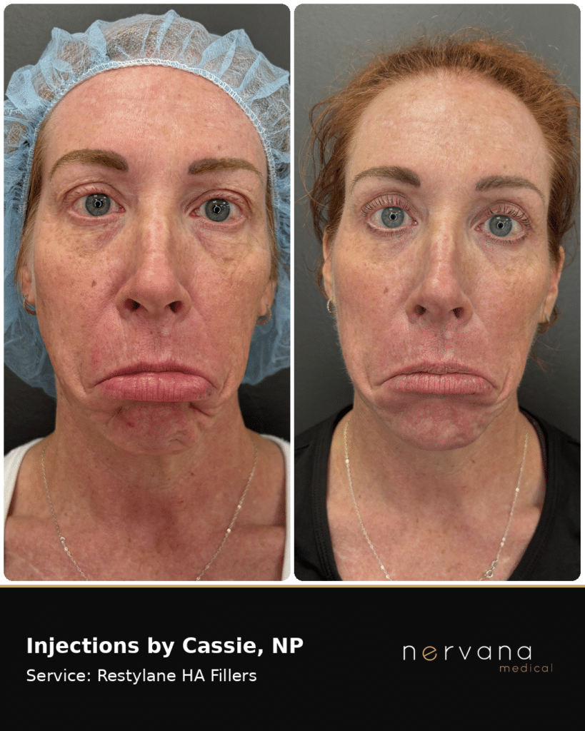 Before and After Image: Restylane Full-Face Filler Before & After, Sandy UT (Second Case) - front