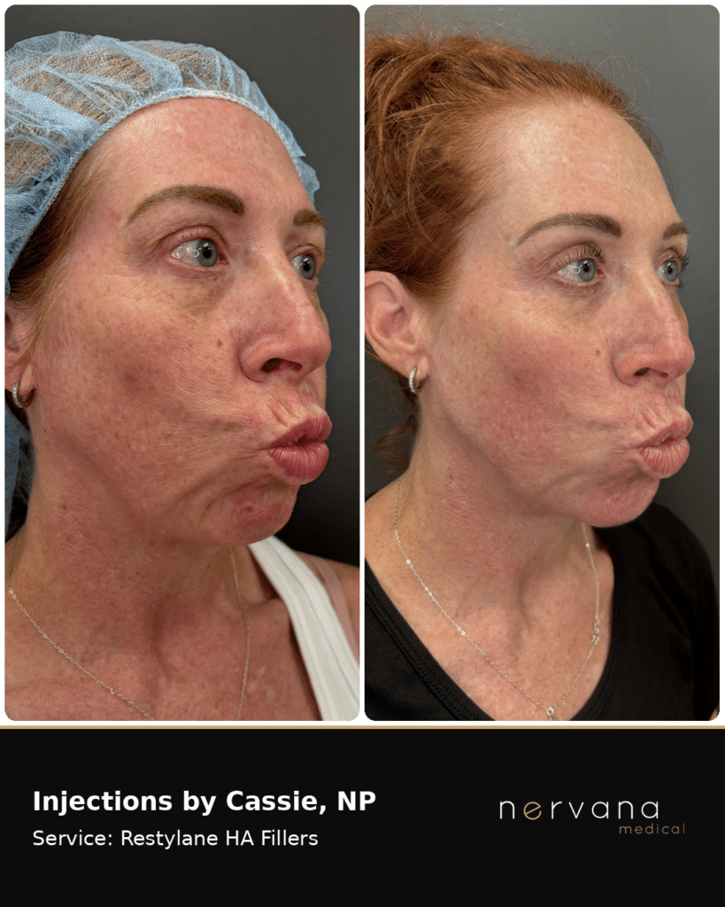 Before and After Image: Restylane Full-Face Filler Before & After, Sandy UT (Second Case) - right-front-oblique