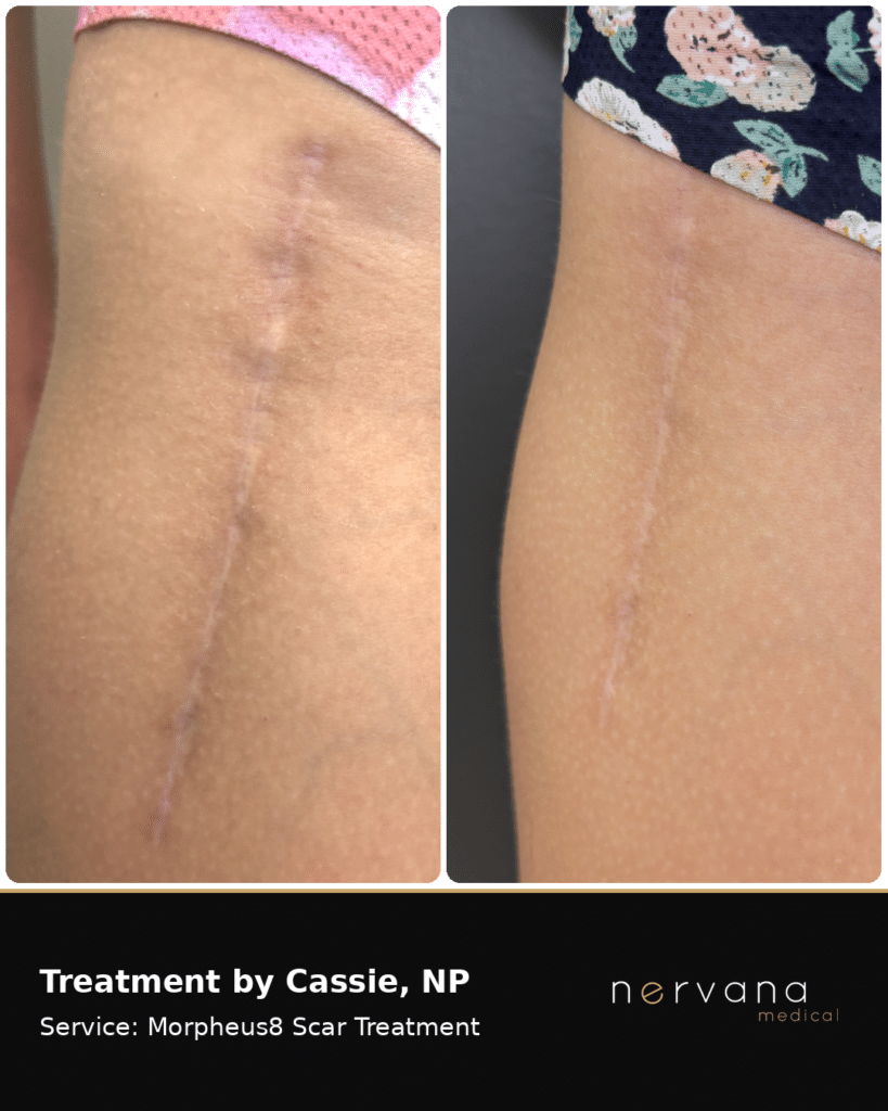 Before and After Image: Morpheus8 Scar Treatment Before and After | Sandy, UT - other