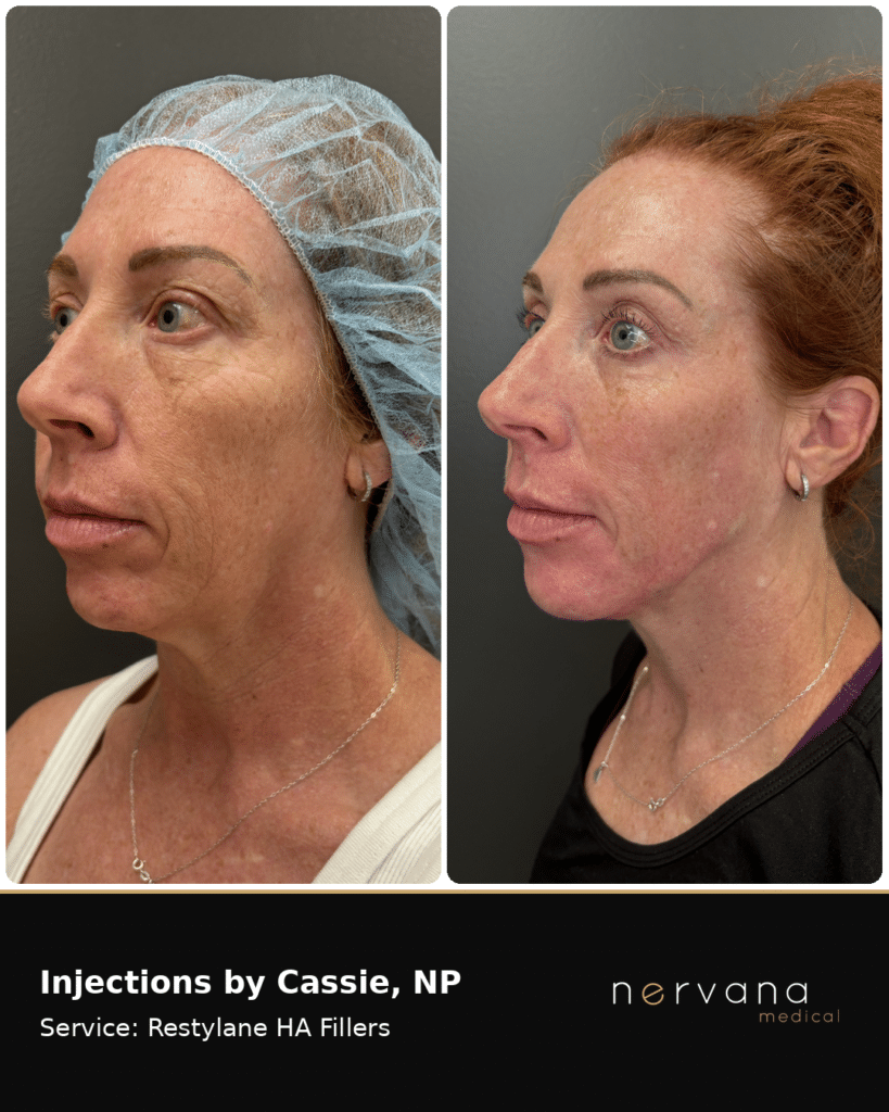 Before and After Image: Restylane Full-Face Filler Before & After, Sandy UT (Second Case) - left-front-oblique