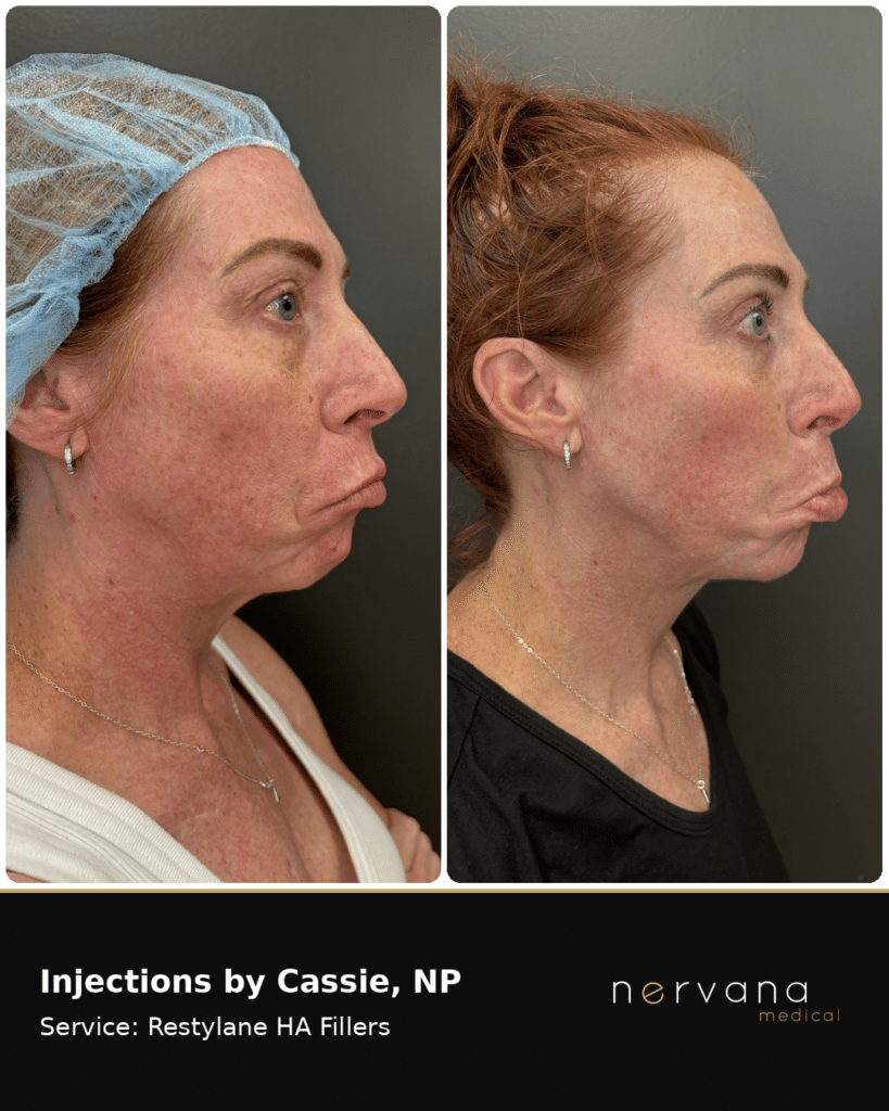 Before and After Image: Restylane Full-Face Filler Before & After, Sandy UT (Second Case) - right-side