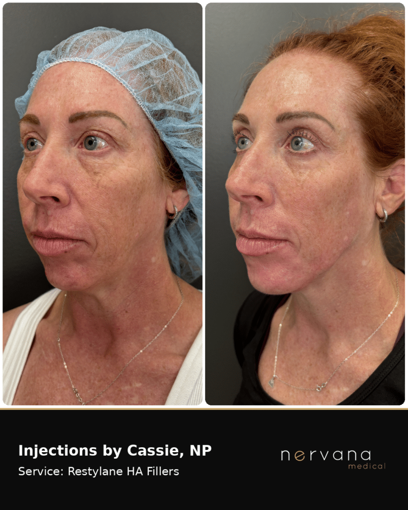 Before and After Image: Restylane Full-Face Filler Before & After, Sandy UT (Second Case) - left-front-oblique