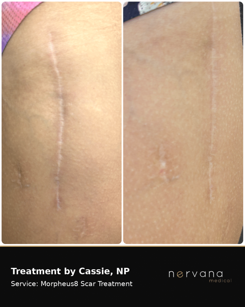 Before and After Image: Morpheus8 Scar Treatment Before and After | Sandy, UT - back