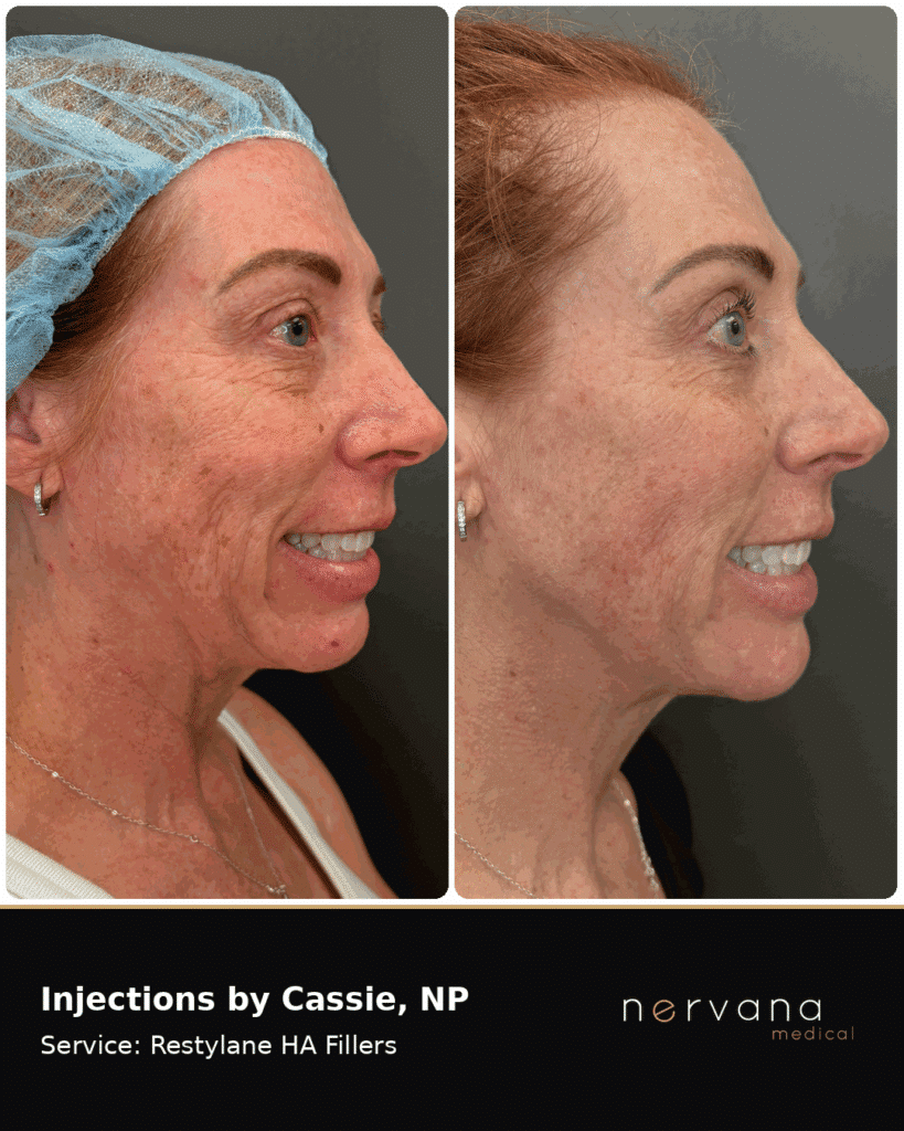 Before and After Image: Restylane Full-Face Filler Before & After, Sandy UT (Second Case) - right-side
