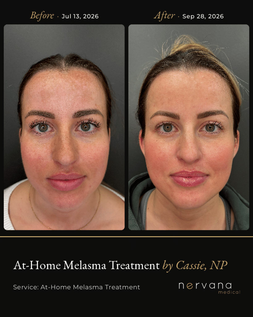 Before and After Image: At Home Melasma Treatment - front