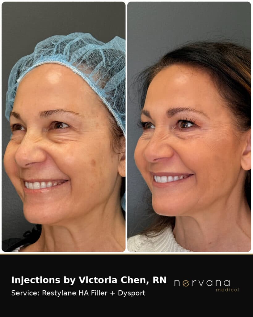 Before and After Image: Restylane + Dysport Facial Before & After | Sandy UT - front