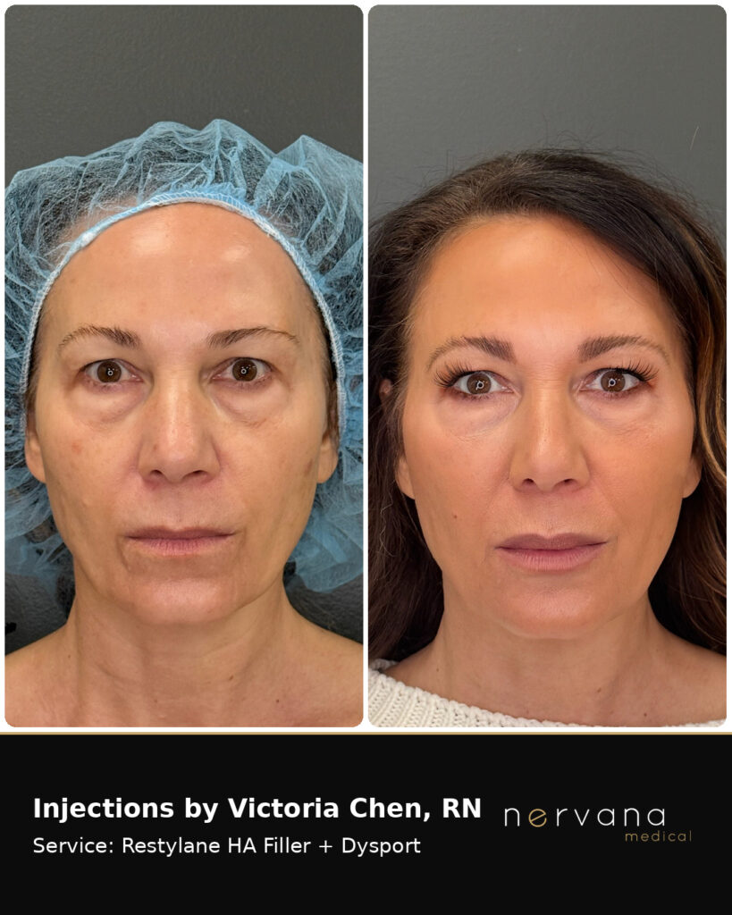 Before and After Image: Restylane + Dysport Facial Before & After | Sandy UT - back