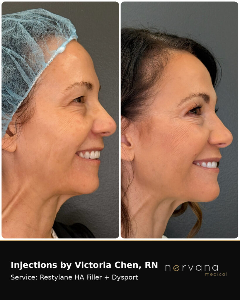 Before and After Image: Restylane + Dysport Facial Before & After | Sandy UT - front