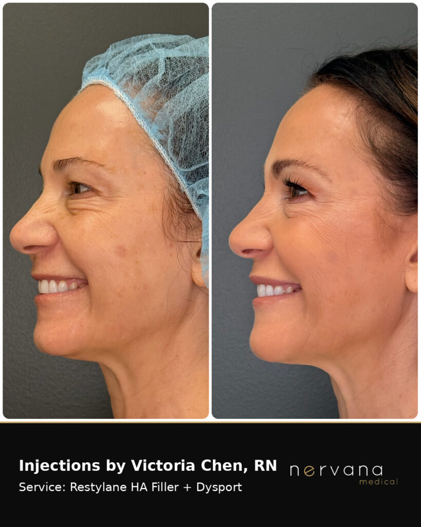 Before and After Image: Restylane + Dysport Facial Before & After | Sandy UT - front