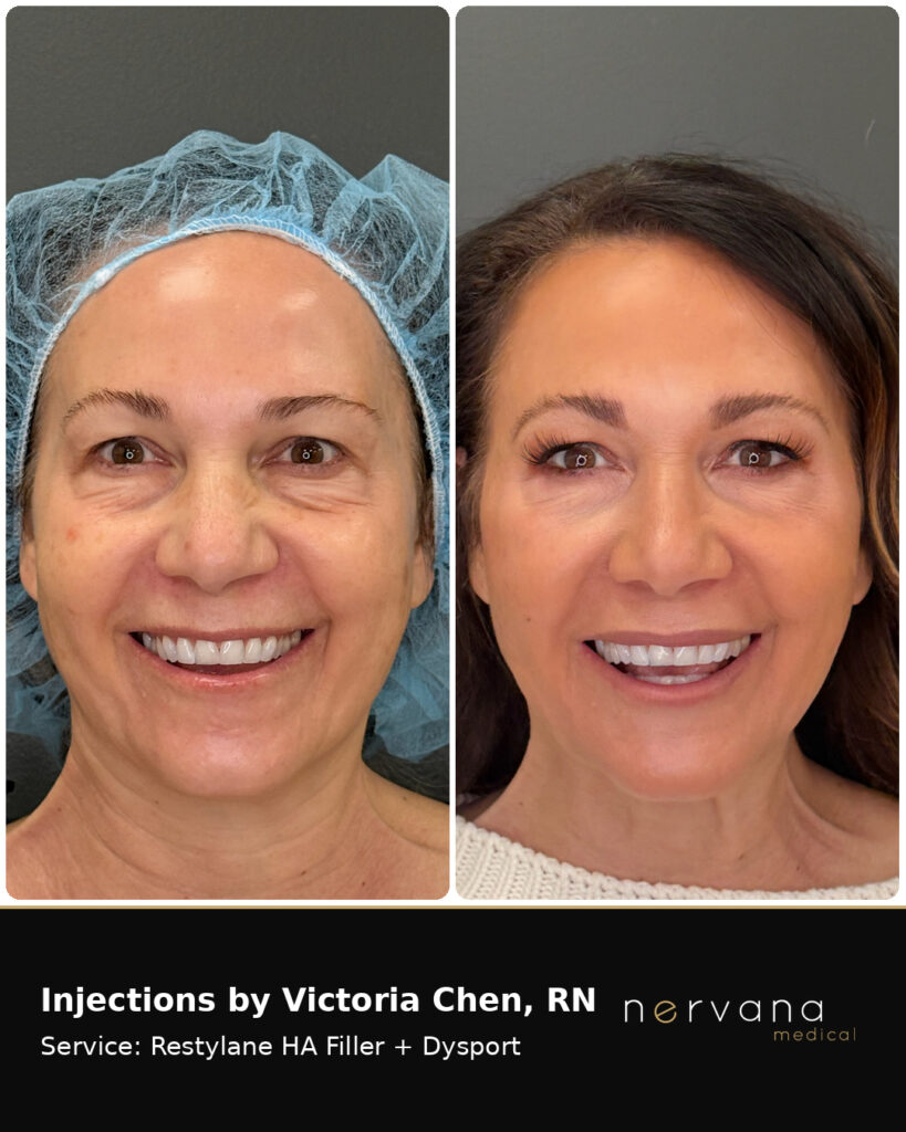 Before and After Image: Restylane + Dysport Facial Before & After | Sandy UT - front